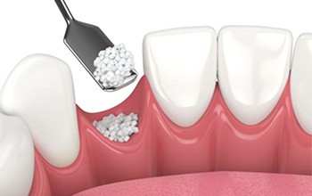 Illustration of bone grafting material being placed into empty socket after tooth extraction