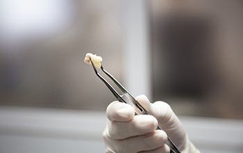 Dentist holding a tooth with tweezers