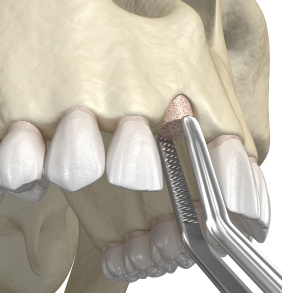Animated smile during socket preservation treatment