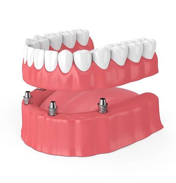 Illustration of implant dentures in Roslyn being placed on lower arch