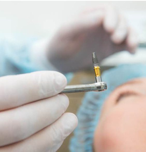 Close up of oral surgeon holding a dental implant post