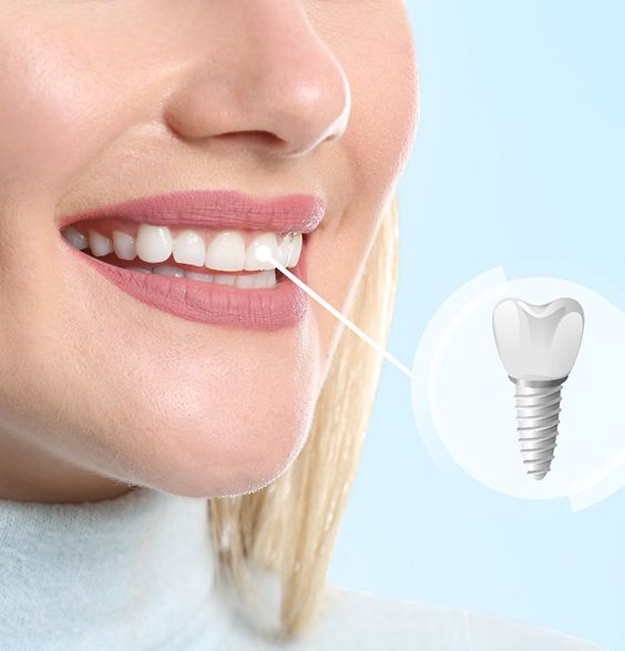 Close up of a woman smiling with a dental implant