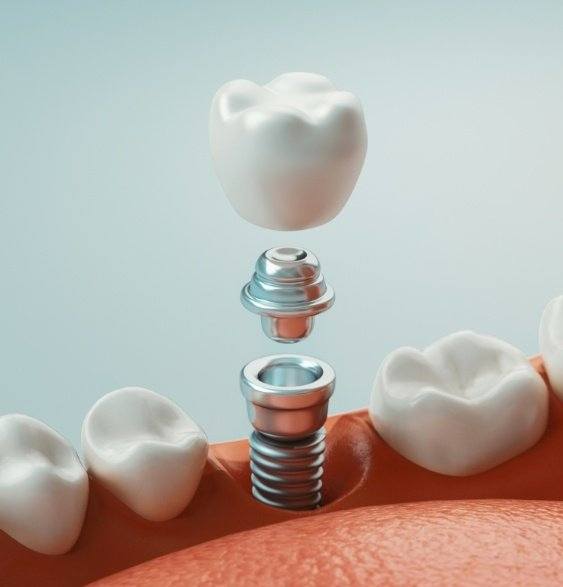 Animated smile showing the four step dental implant process