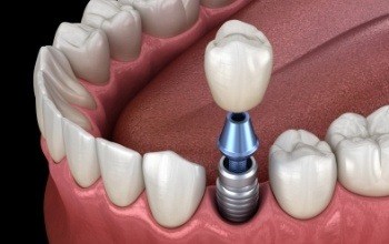 Illustrated dental crown being placed over a dental implant