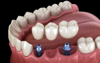 Illustrated dental bridge being placed over two dental implants