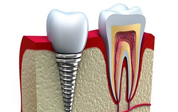 Illustration of tooth and a single dental implant in the lower jaw