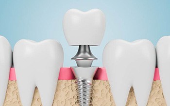 Illustrated dental implant in lower jaw with abutment and crown