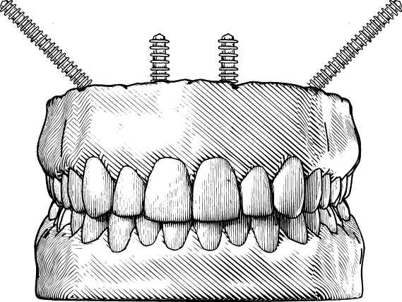 Illustration of mouth with zygomatic dental implants