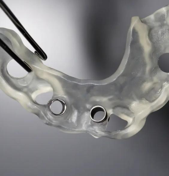 3 D printed dental implant surgical guide