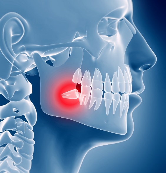 3 D animated smile showing impacted wisdom tooth