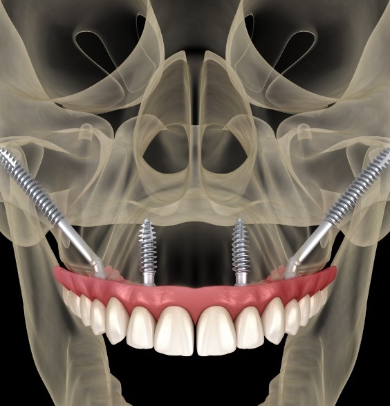 Animated smile showing zygomatic dental implant restoration