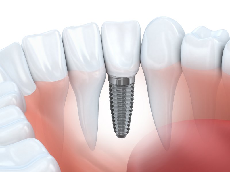 3-D model of a dental implant