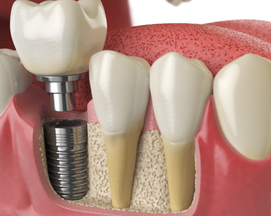 3D image of a dental implant