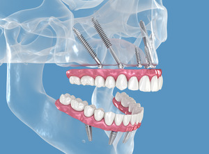 Illustration of zygomatic dental implants in upper jaw